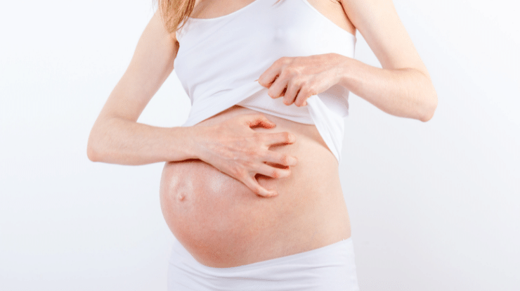 itching during pregnancy